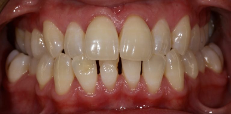 KA Before Whitening copy