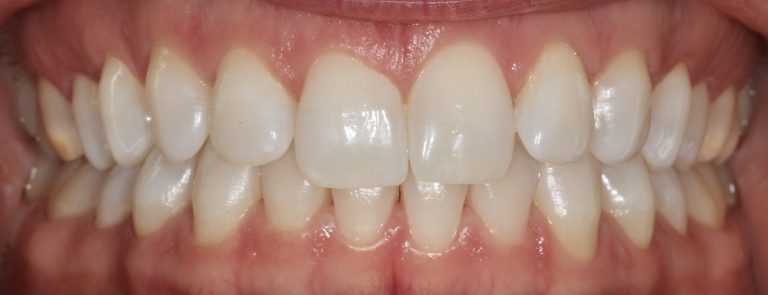 Teeth Whitening II After copy