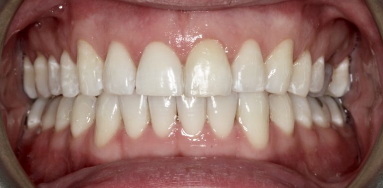 Teeth Whitening III After copy