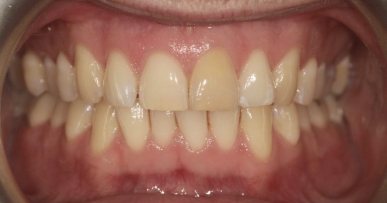 Teeth Whitening III Before copy